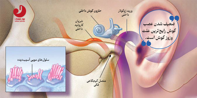 نوار گوش برای وزوز گوش